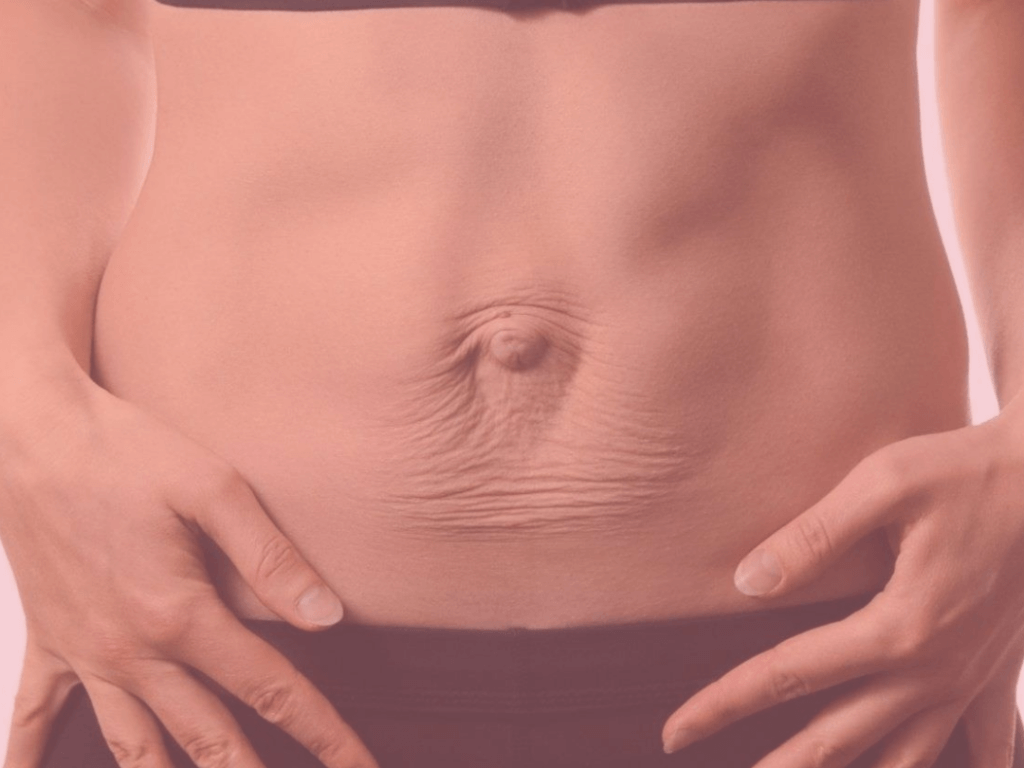 Diastasis abdominal