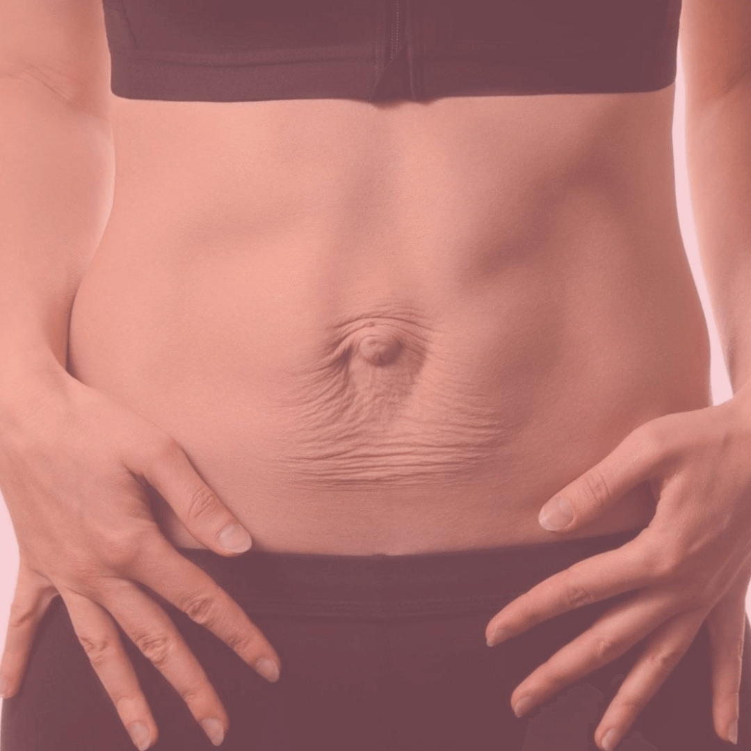 Diastasis abdominal