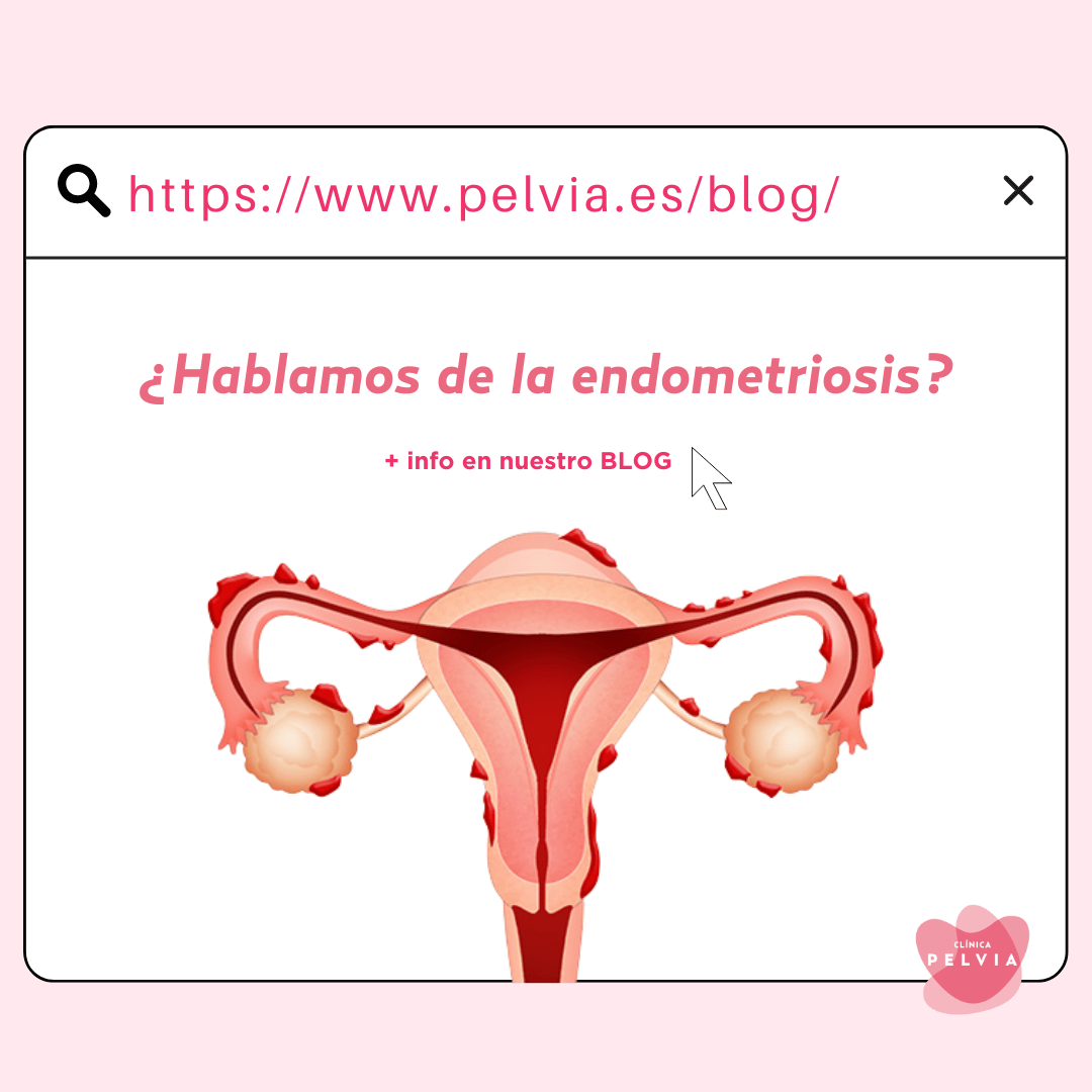 endometriosis